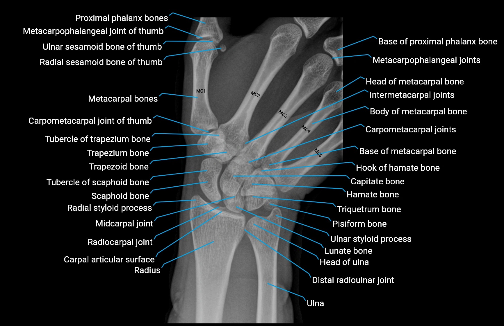 x ray wrist scaphoid ulnar deviation labelled anatomy image.webp